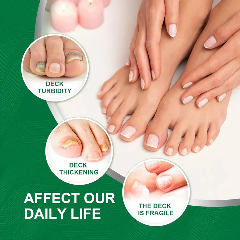 Nail Fungus Treatment