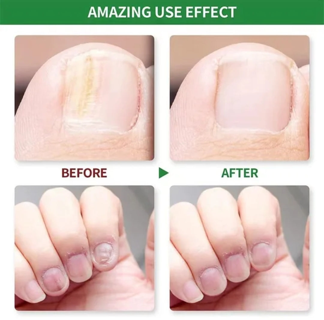 Nail Fungus Treatment