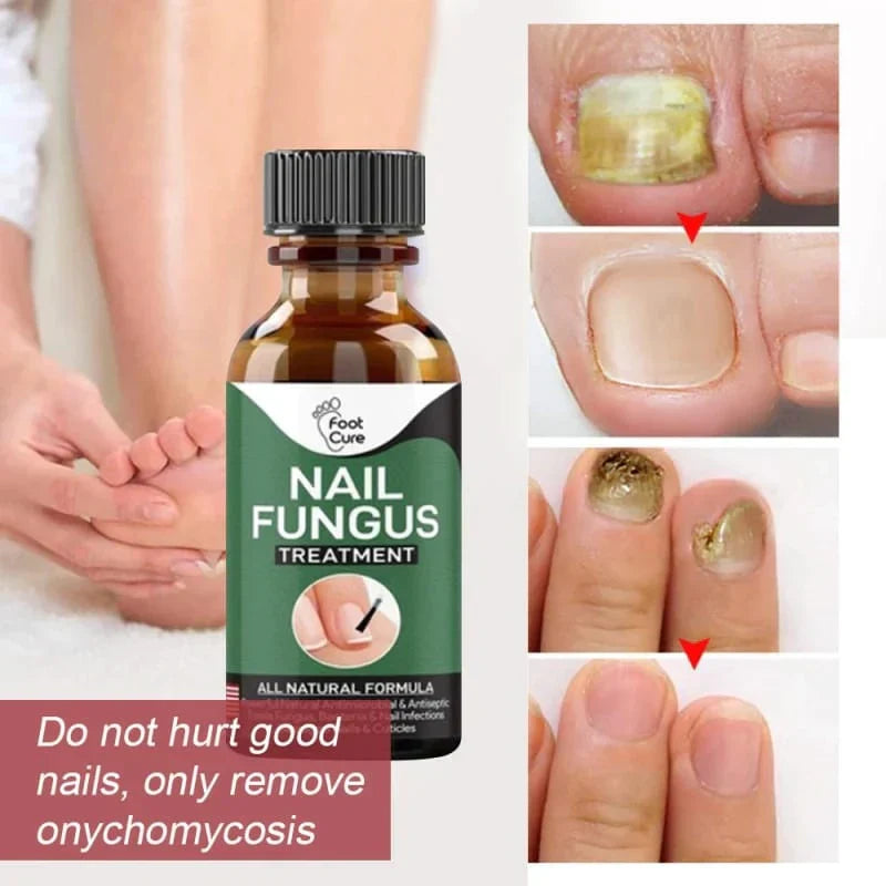 Nail Fungus Treatment