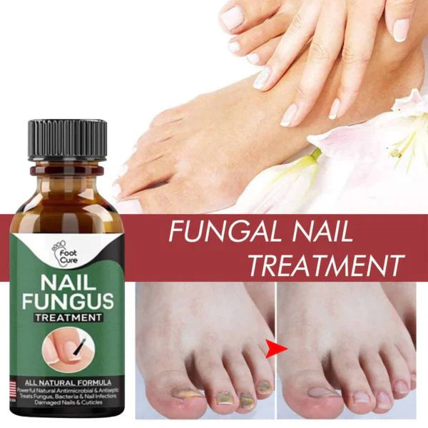 Nail Fungus Treatment